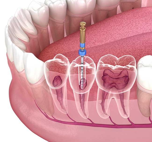 Root Canal